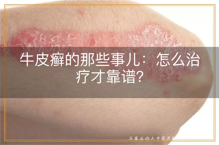 牛皮癣的那些事儿：怎么治疗才靠谱？