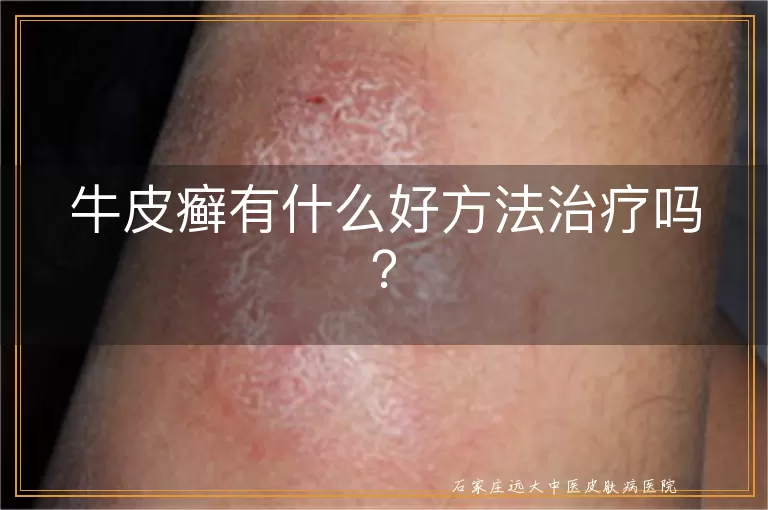 牛皮癣有什么好方法治疗吗？