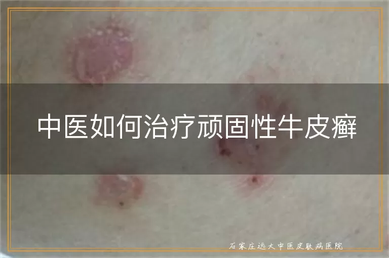 中医如何治疗顽固性牛皮癣