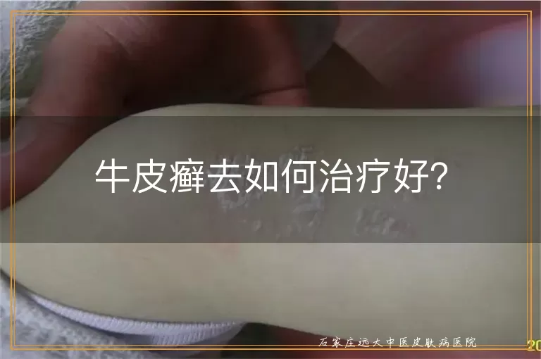 牛皮癣去如何治疗好？