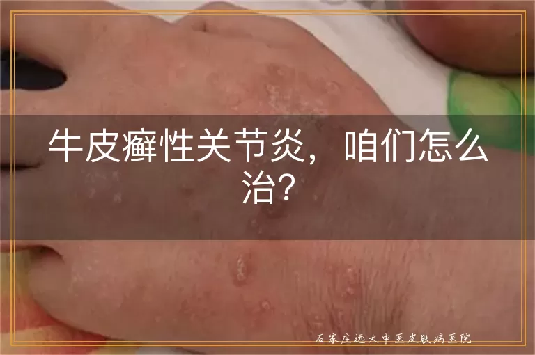 牛皮癣性关节炎，咱们怎么治？