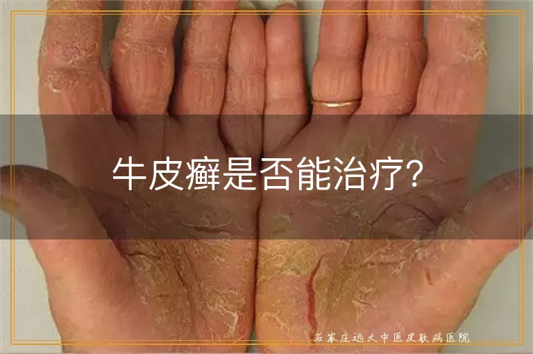 牛皮癣是否能治疗？