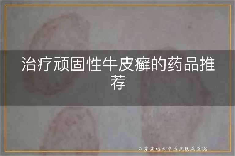 治疗顽固性牛皮癣的药品推荐