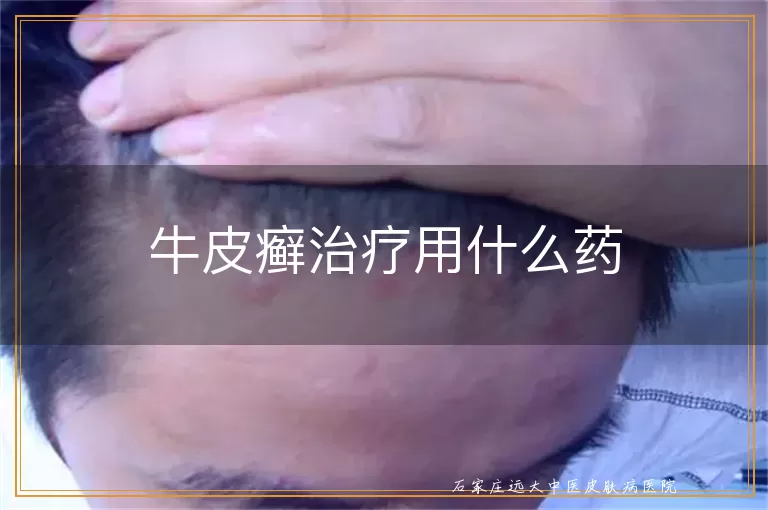 牛皮癣治疗用什么药