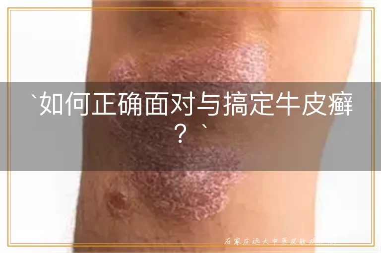 如何正确面对与搞定牛皮癣？