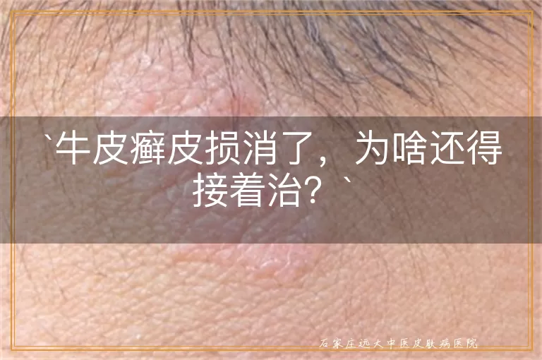 牛皮癣皮损消了，为啥还得接着治？