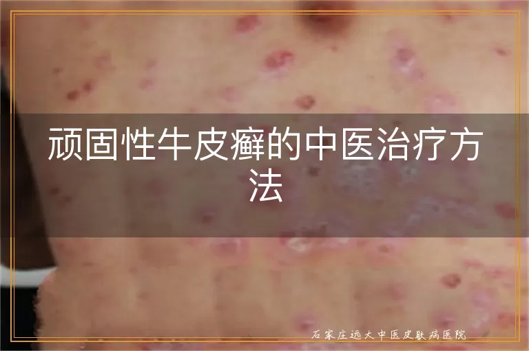 顽固性牛皮癣的中医治疗方法