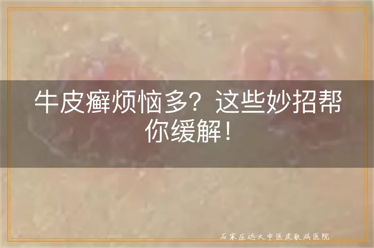 牛皮癣烦恼多？这些妙招帮你缓解！