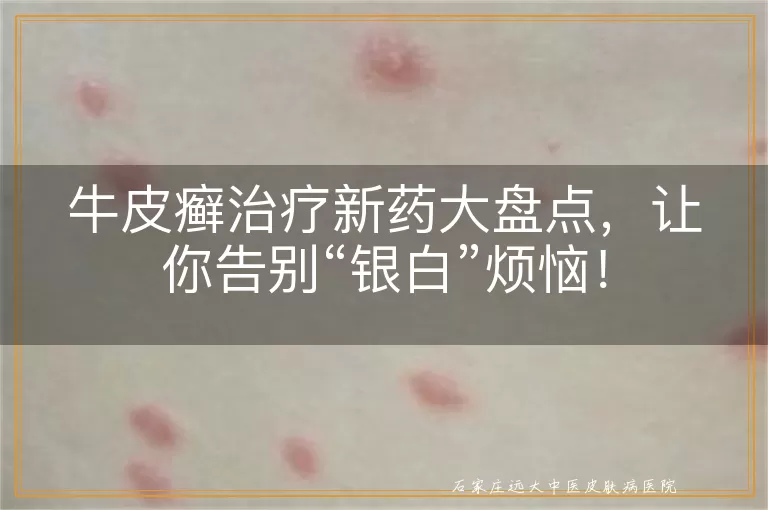 牛皮癣治疗新药大盘点，让你告别“银白”烦恼！