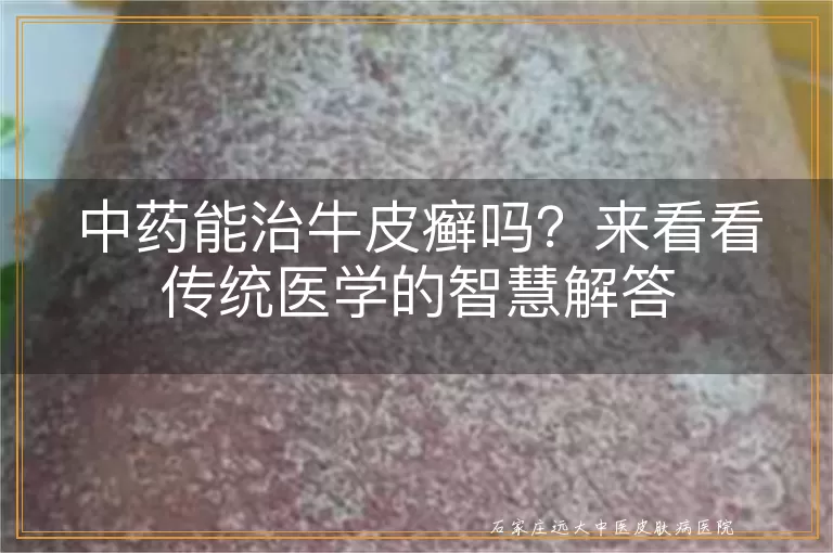 中药能治牛皮癣吗？来看看传统医学的智慧解答