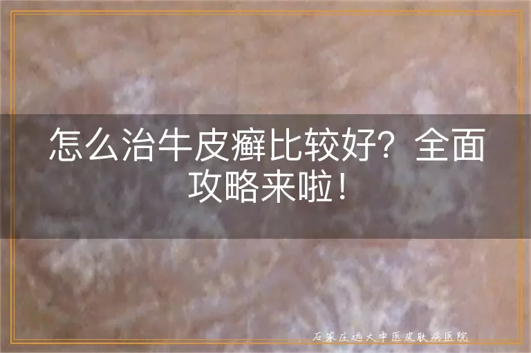 怎么治牛皮癣比较好？全面攻略来啦！