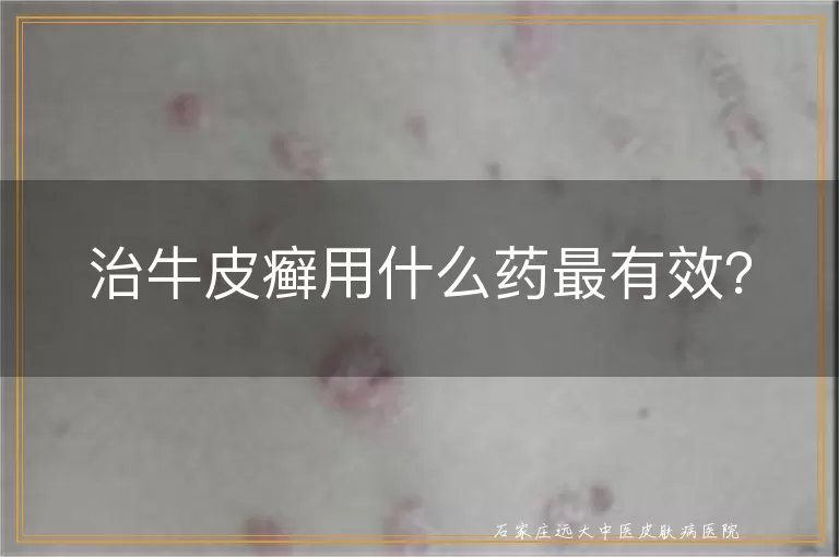 治牛皮癣用什么药最有效？