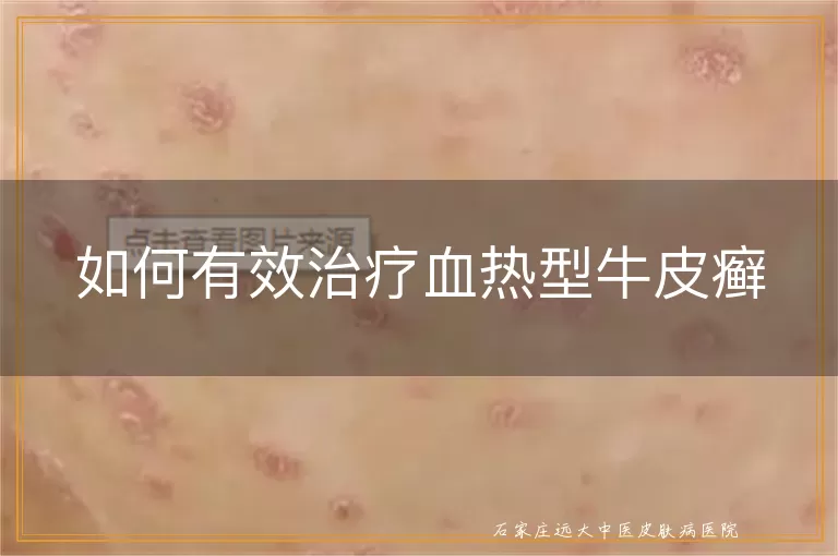 如何有效治疗血热型牛皮癣