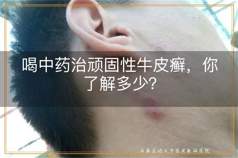 喝中药治顽固性牛皮癣，你了解多少？