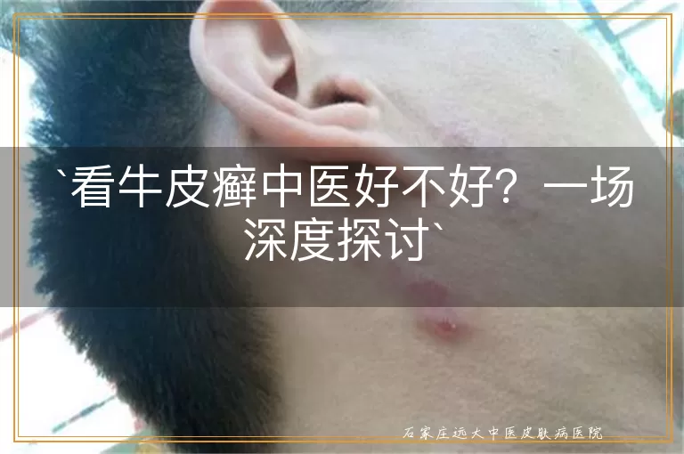 看牛皮癣中医好不好？一场深度探讨