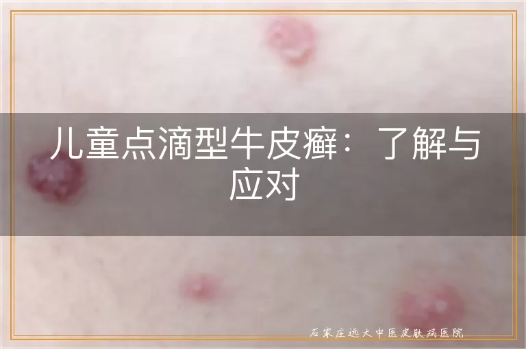 儿童点滴型牛皮癣：了解与应对