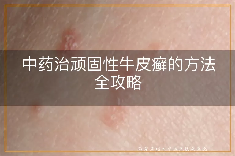 中药治顽固性牛皮癣的方法全攻略