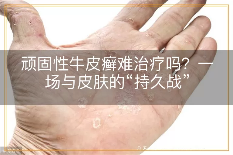 顽固性牛皮癣难治疗吗？一场与皮肤的“持久战”