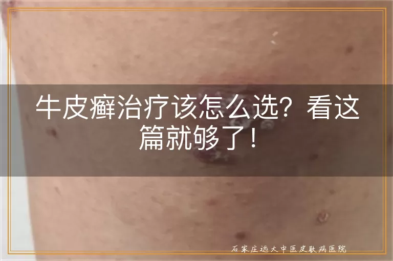 牛皮癣治疗该怎么选？看这篇就够了！