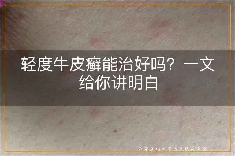 轻度牛皮癣能治好吗？一文给你讲明白