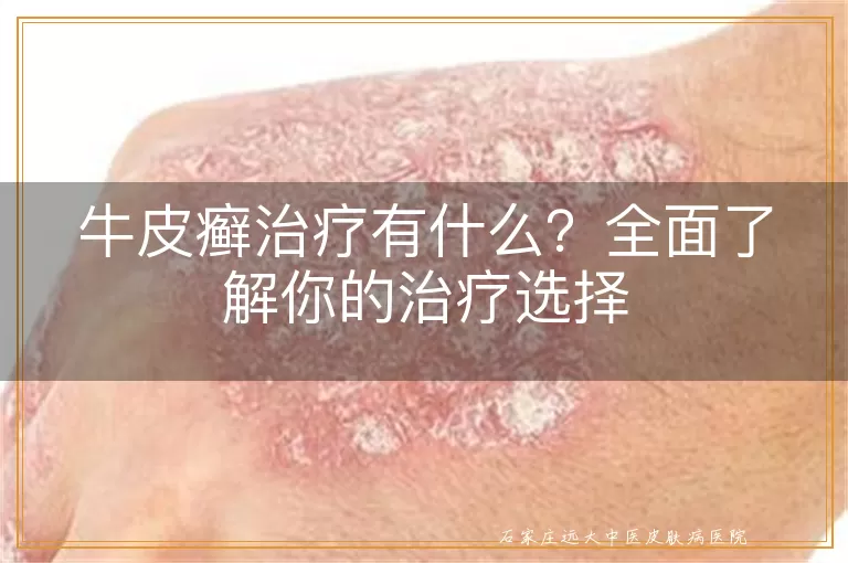 牛皮癣治疗有什么？全面了解你的治疗选择