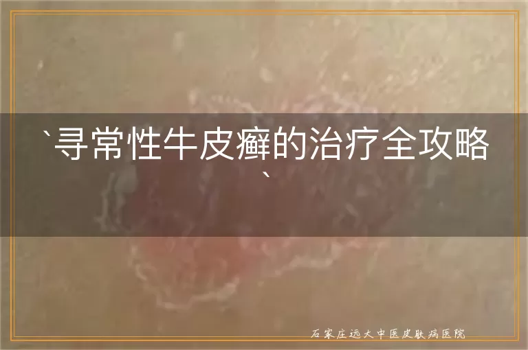 寻常性牛皮癣的治疗全攻略