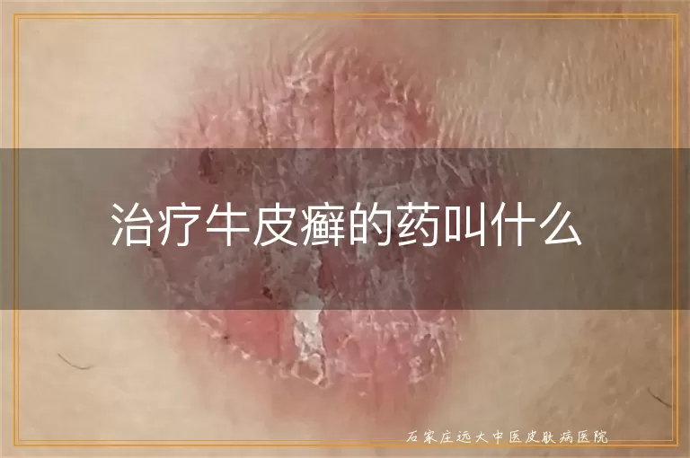 治疗牛皮癣的药叫什么