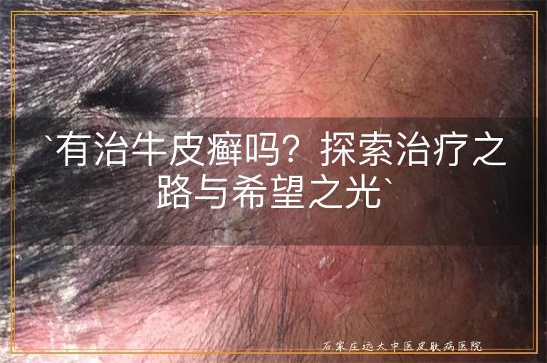 有治牛皮癣吗？探索治疗之路与希望之光