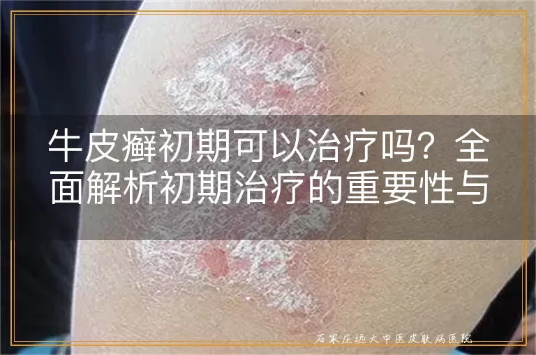 牛皮癣初期可以治疗吗？全面解析初期治疗的重要性与方案