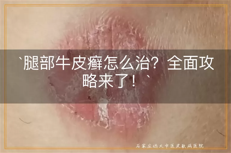 腿部牛皮癣怎么治？全面攻略来了！