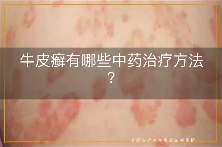 牛皮癣有哪些中药治疗方法？