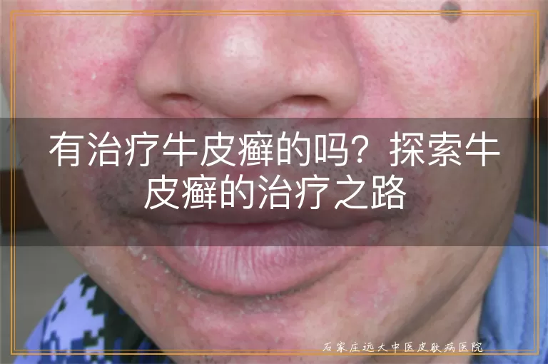 有治疗牛皮癣的吗？探索牛皮癣的治疗之路