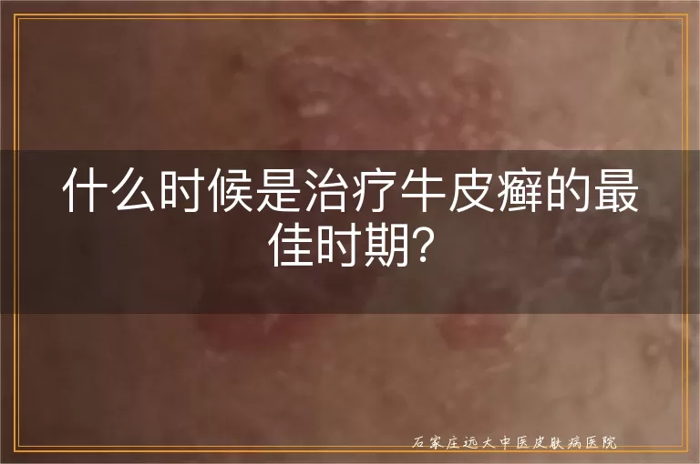 什么时候是治疗牛皮癣的最佳时期？