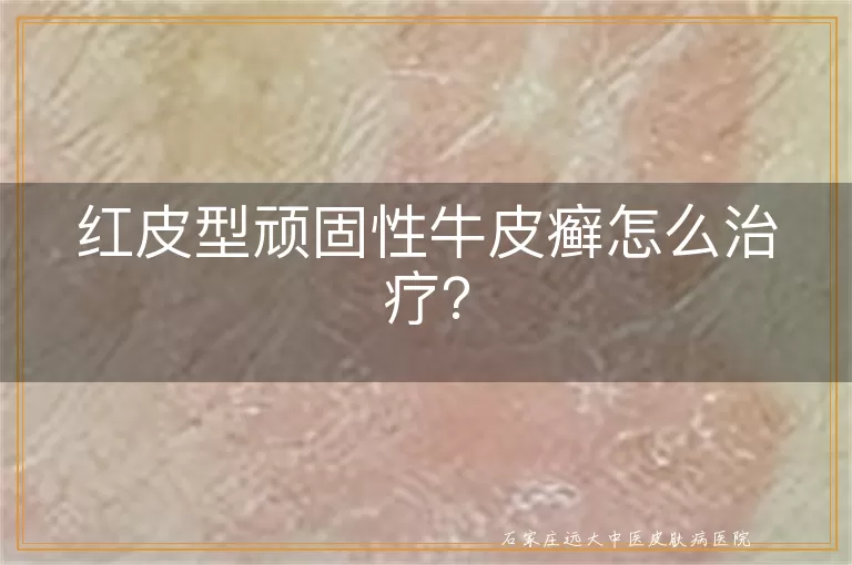 红皮型顽固性牛皮癣怎么治疗？