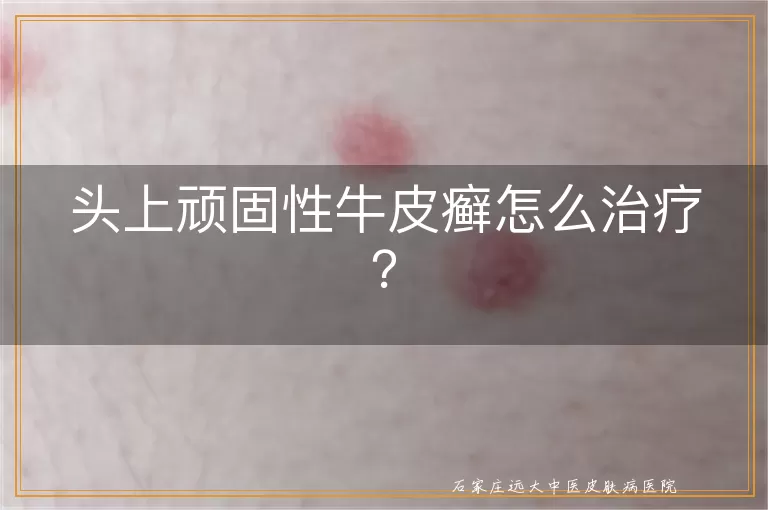 头上顽固性牛皮癣怎么治疗？