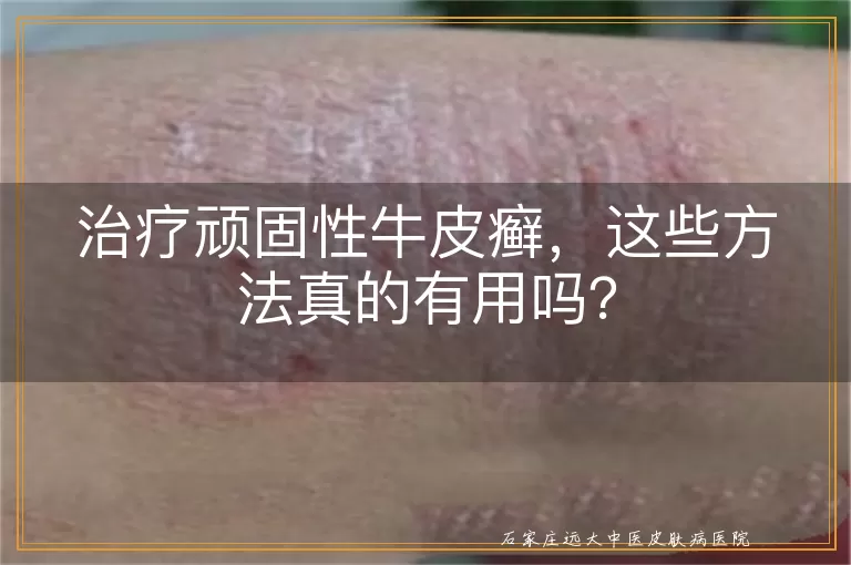 治疗顽固性牛皮癣，这些方法真的有用吗？