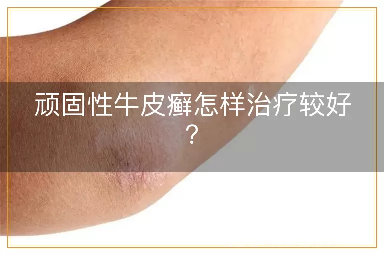 顽固性牛皮癣怎样治疗较好？