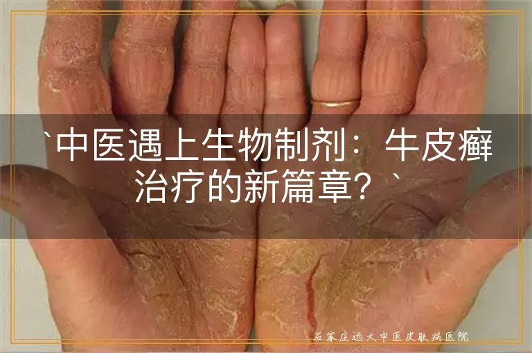 中医遇上生物制剂：牛皮癣治疗的新篇章？