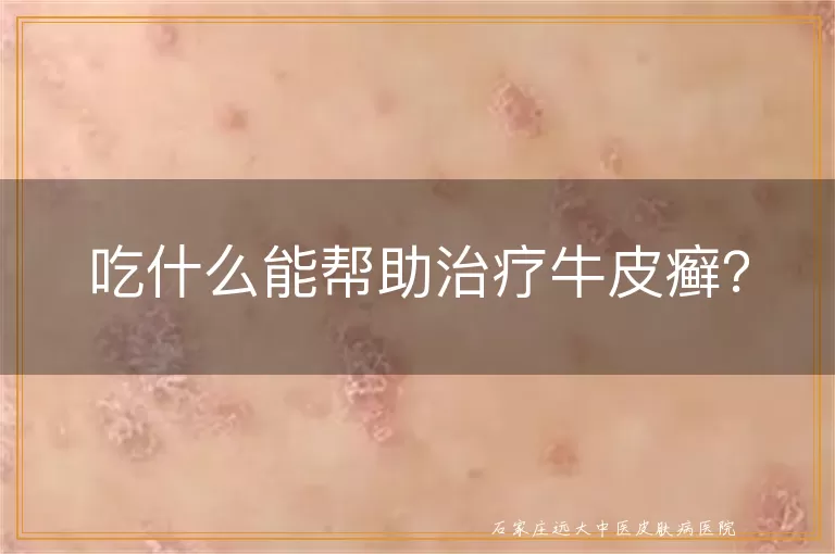 吃什么能帮助治疗牛皮癣？