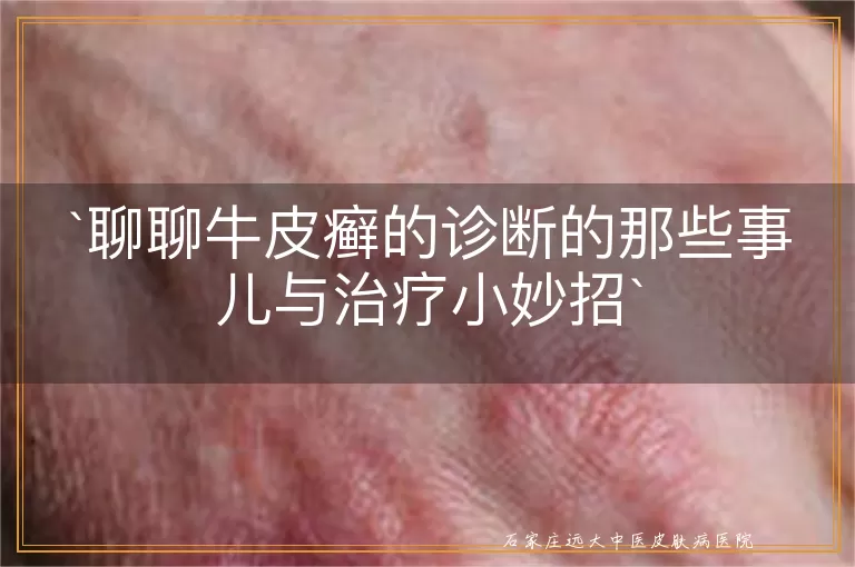 聊聊牛皮癣的诊断的那些事儿与治疗小妙招