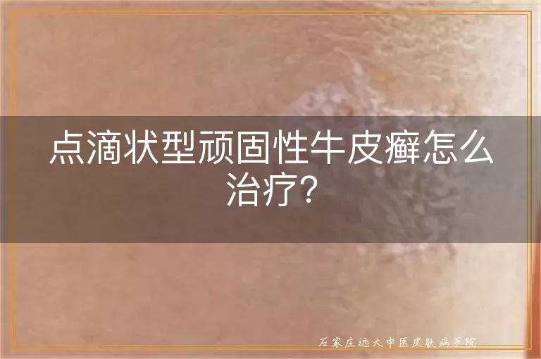 点滴状型顽固性牛皮癣怎么治疗？