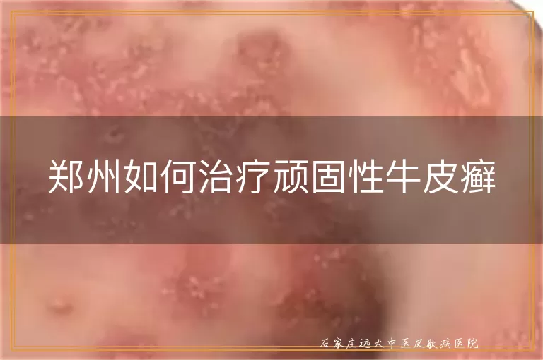 郑州如何治疗顽固性牛皮癣