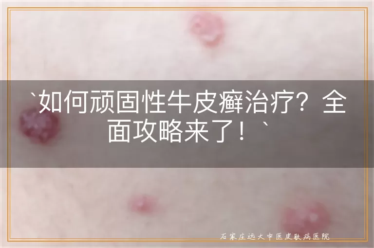 如何顽固性牛皮癣治疗？全面攻略来了！