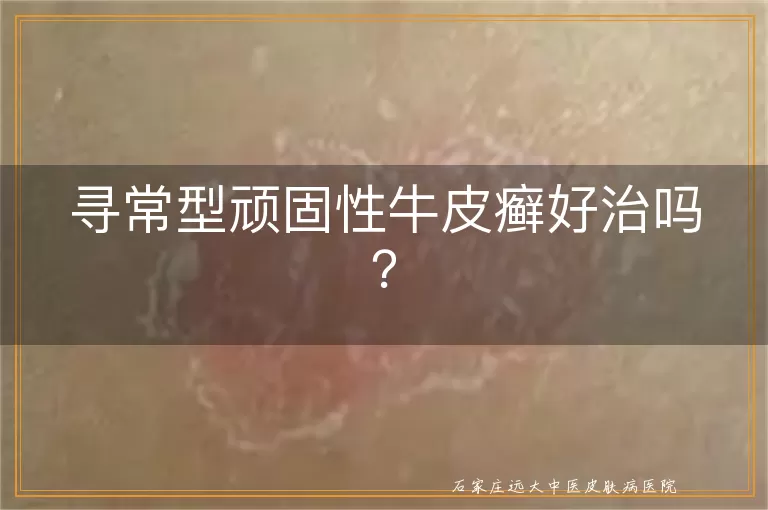 寻常型顽固性牛皮癣好治吗？