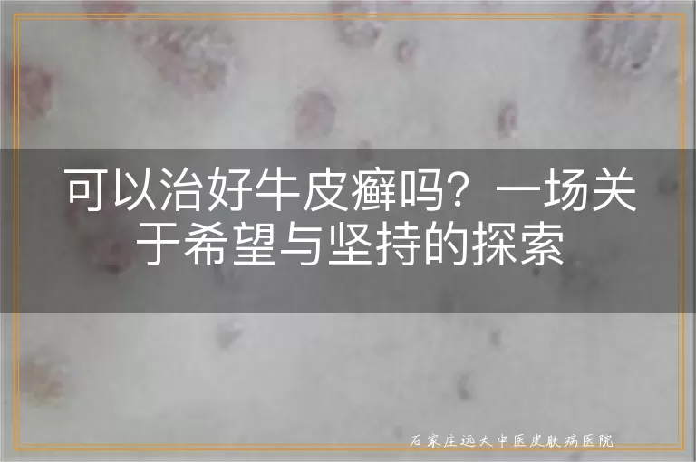 可以治好牛皮癣吗？一场关于希望与坚持的探索