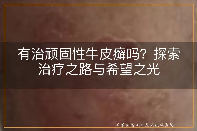 有治顽固性牛皮癣吗？探索治疗之路与希望之光