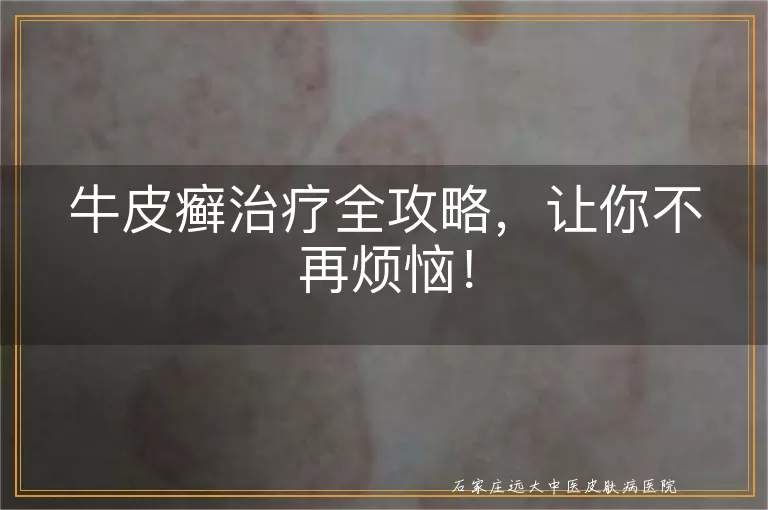 牛皮癣治疗全攻略，让你不再烦恼！