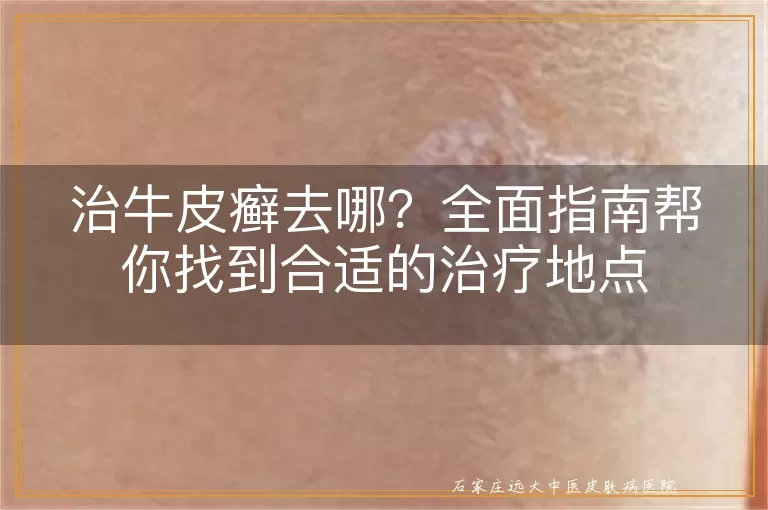 治牛皮癣去哪？全面指南帮你找到合适的治疗地点