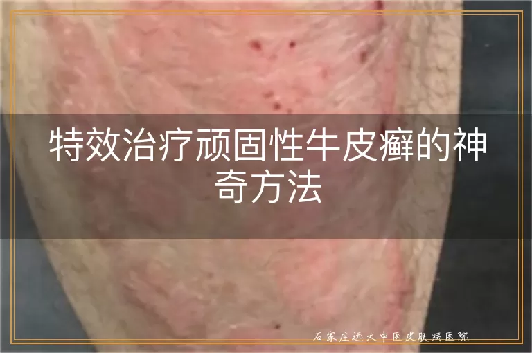 特效治疗顽固性牛皮癣的神奇方法