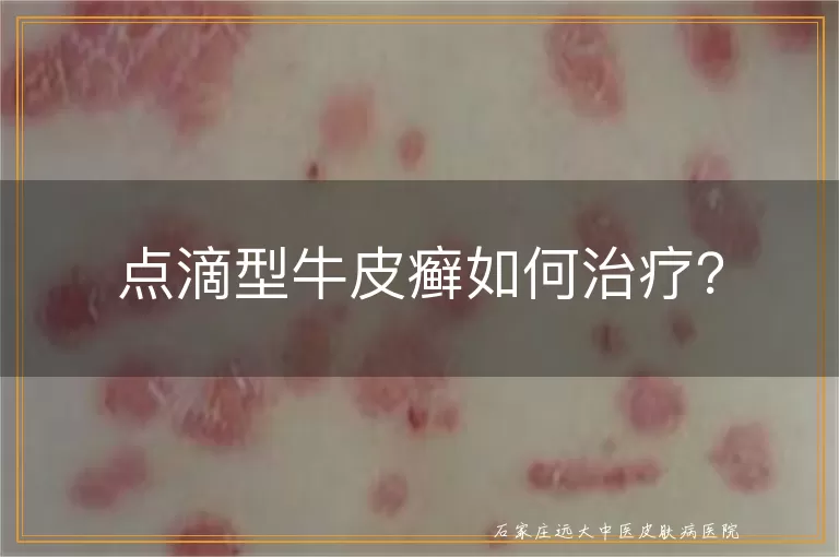 点滴型牛皮癣如何治疗？